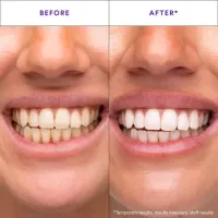 🔥🔥Hot Deal Summer SALE OFF UP TO 60%🔥🔥Transform Your Smile - Within 30 Minutes! With Whitening Trips thumbnail 3