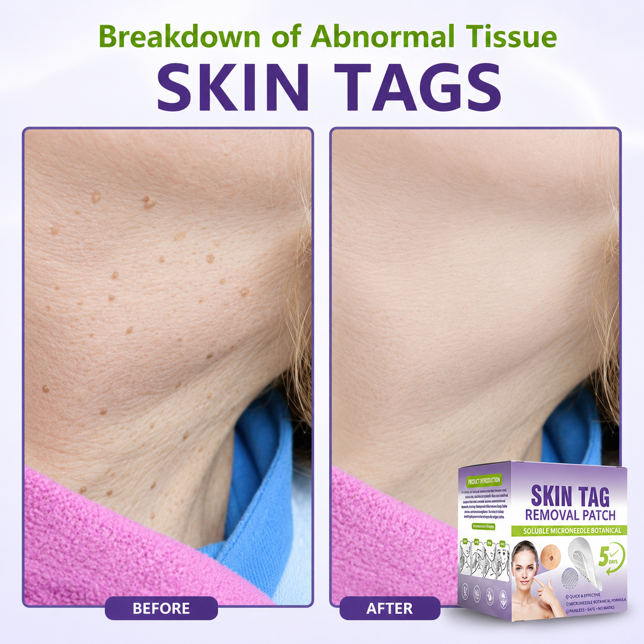 🔥 SALE OFF UP TO 60%🔥💥 Soluble Microneedle Botanical Skin Tag Removal Patch thumbnail 8