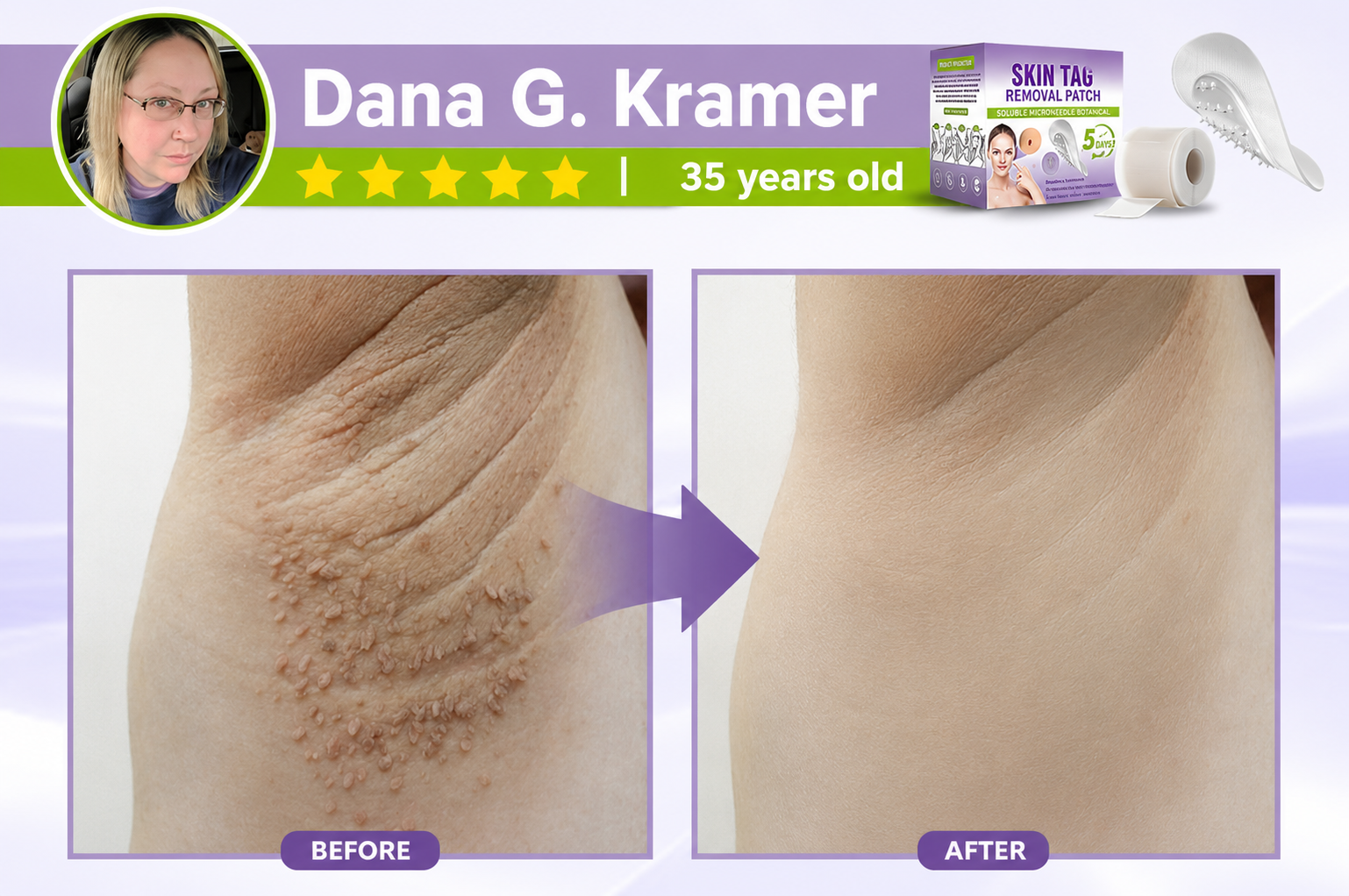 🔥 SALE OFF UP TO 60%🔥💥 Soluble Microneedle Botanical Skin Tag Removal Patch thumbnail 12