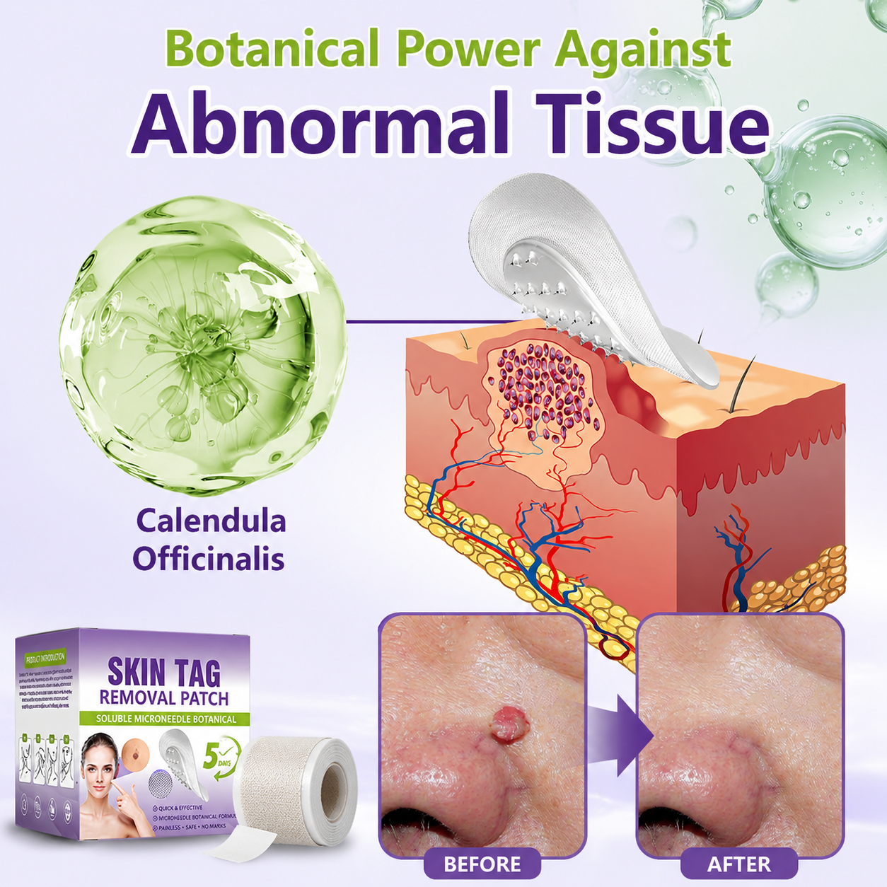 🔥 SALE OFF UP TO 60%🔥💥 Soluble Microneedle Botanical Skin Tag Removal Patch thumbnail 3