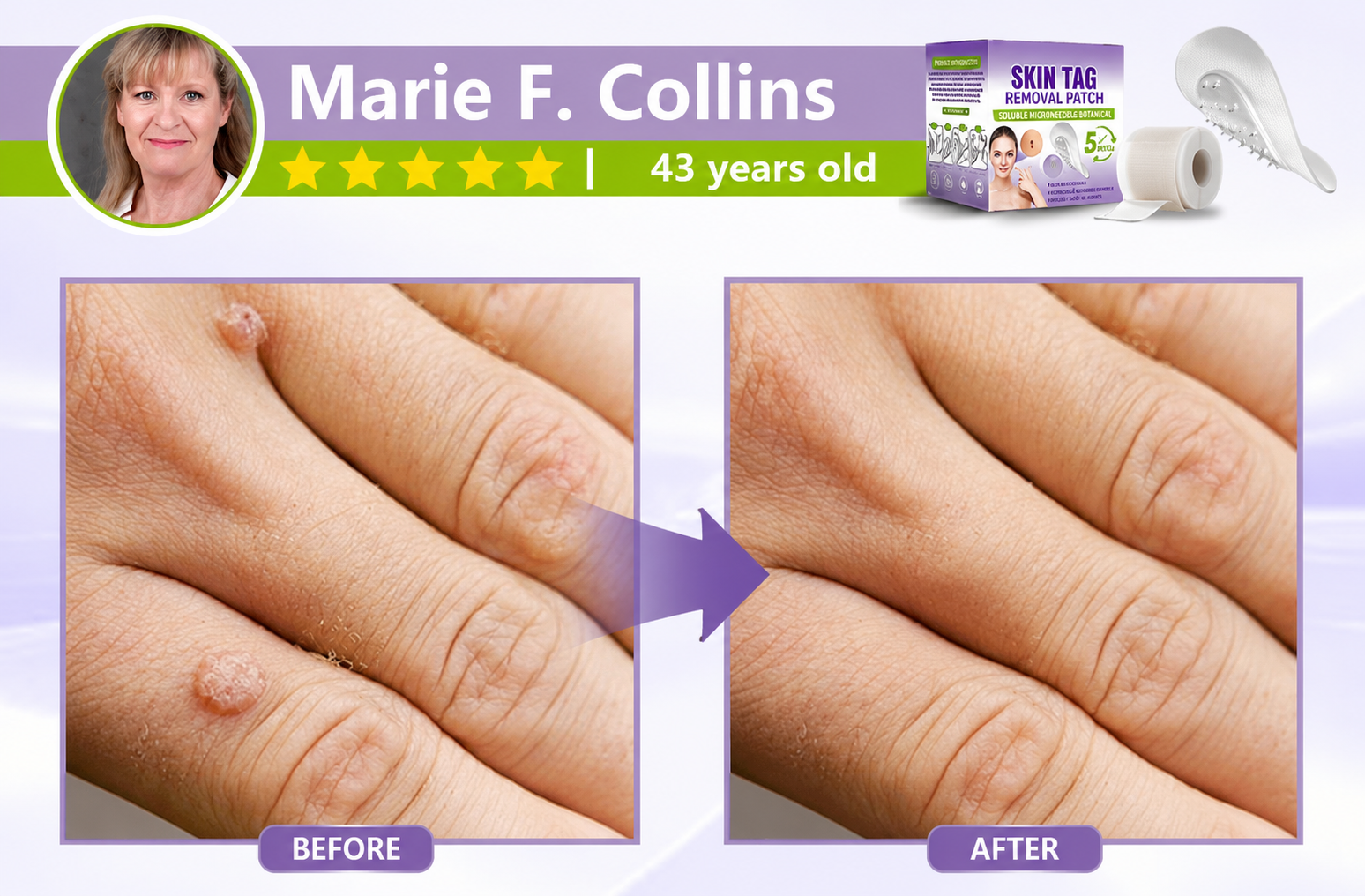 🔥 SALE OFF UP TO 60%🔥💥 Soluble Microneedle Botanical Skin Tag Removal Patch thumbnail 13
