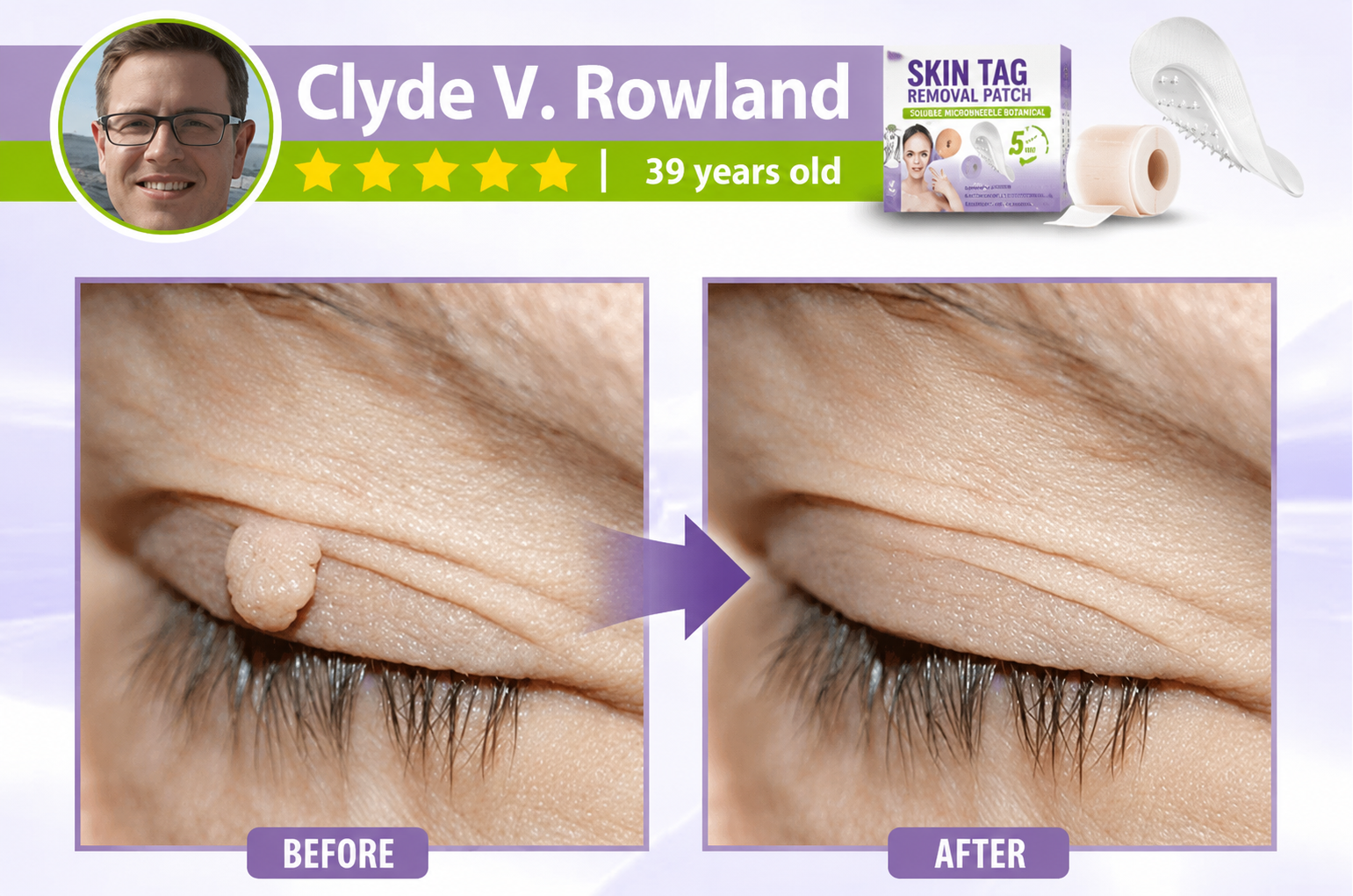 🔥 SALE OFF UP TO 60%🔥💥 Soluble Microneedle Botanical Skin Tag Removal Patch thumbnail 14