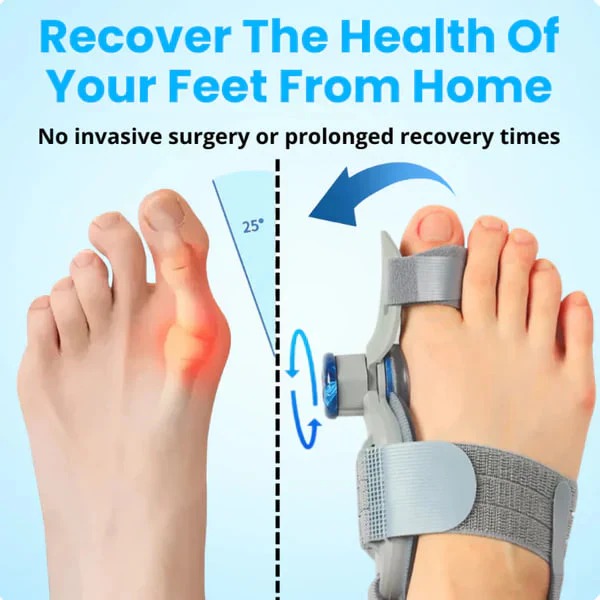 🔥 Summer Sale Upto 60% | AlignToe Pro - Non-Surgical Relief for Bunion Pain thumbnail 6